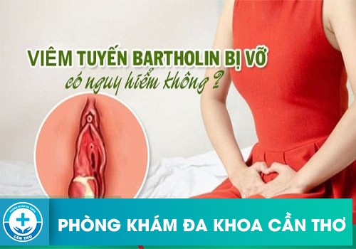 Bệnh viêm tuyến bartholin là gì