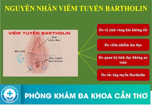 Nguyên nhân dẫn đến viêm tuyến bartholin ở nữ giới