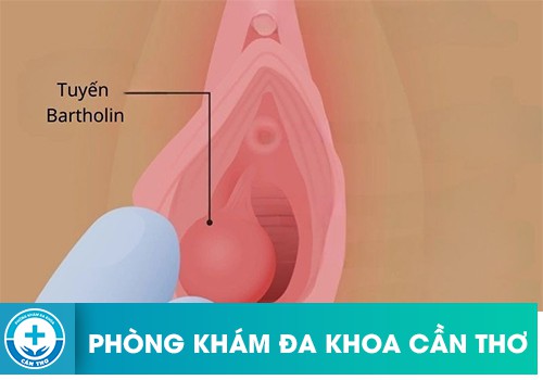 Hình ảnh viêm tuyến Bartholin