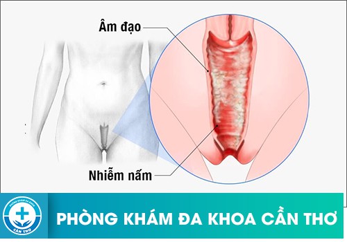 Vùng kín trở nên ẩm ướt do bị viêm nhiễm phụ khoa