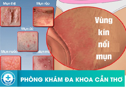 Nổi Mụn Ở Vùng Kín Đang Cảnh Báo Điều Gì