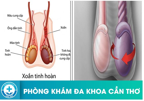 Nguyên nhân xoắn tinh hoàn ở nam